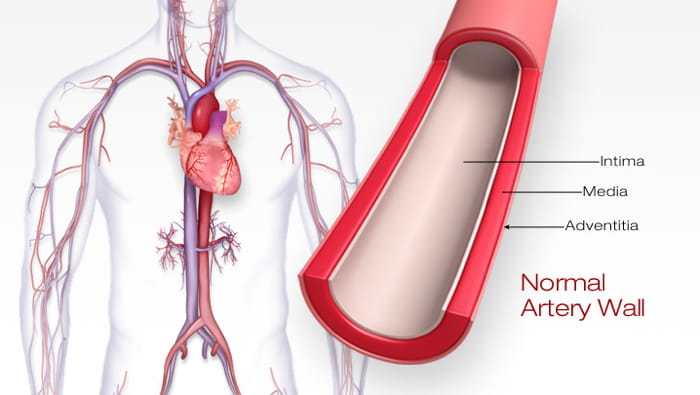 Atherosclerotic plaque in arteries overview • Heart Research Institute