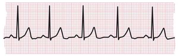ECG strip showing normal heartbeat