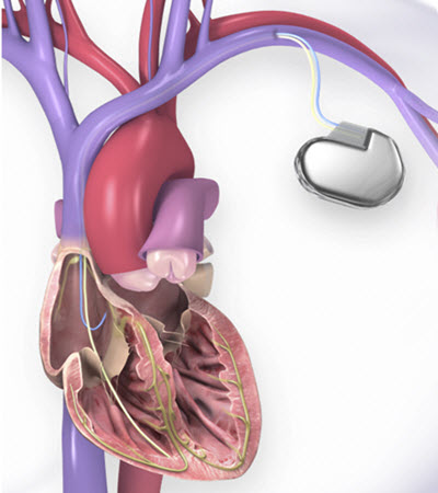 illustration of heart and ICD