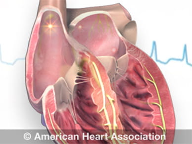AFib