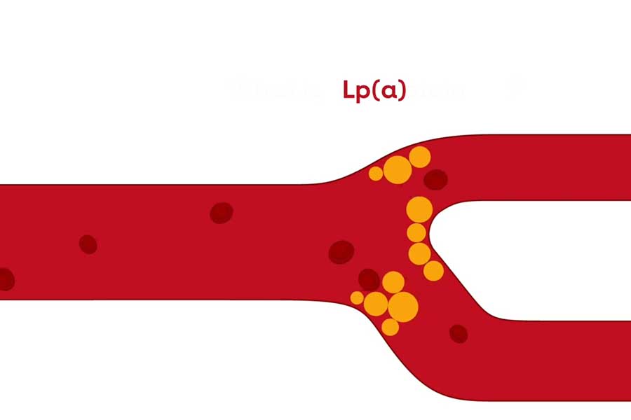 Lipoprotein(a) | American Stroke Association (Asociación Americana del ...