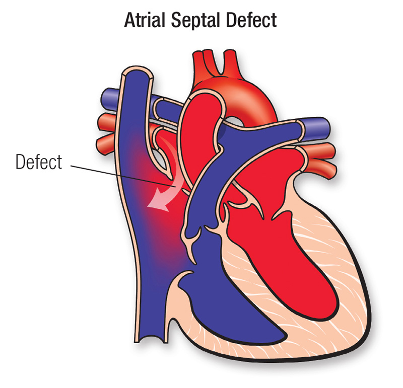atrial septal defect diagram