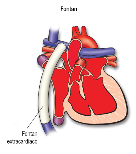 Fontan en AT Español