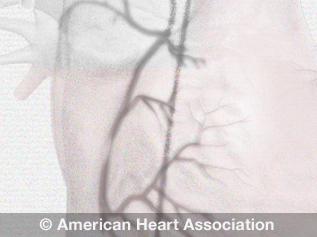 angiogram illustration