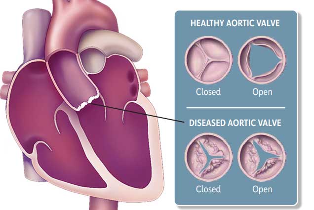 Answers by Heart sheet on aortic stenosis
