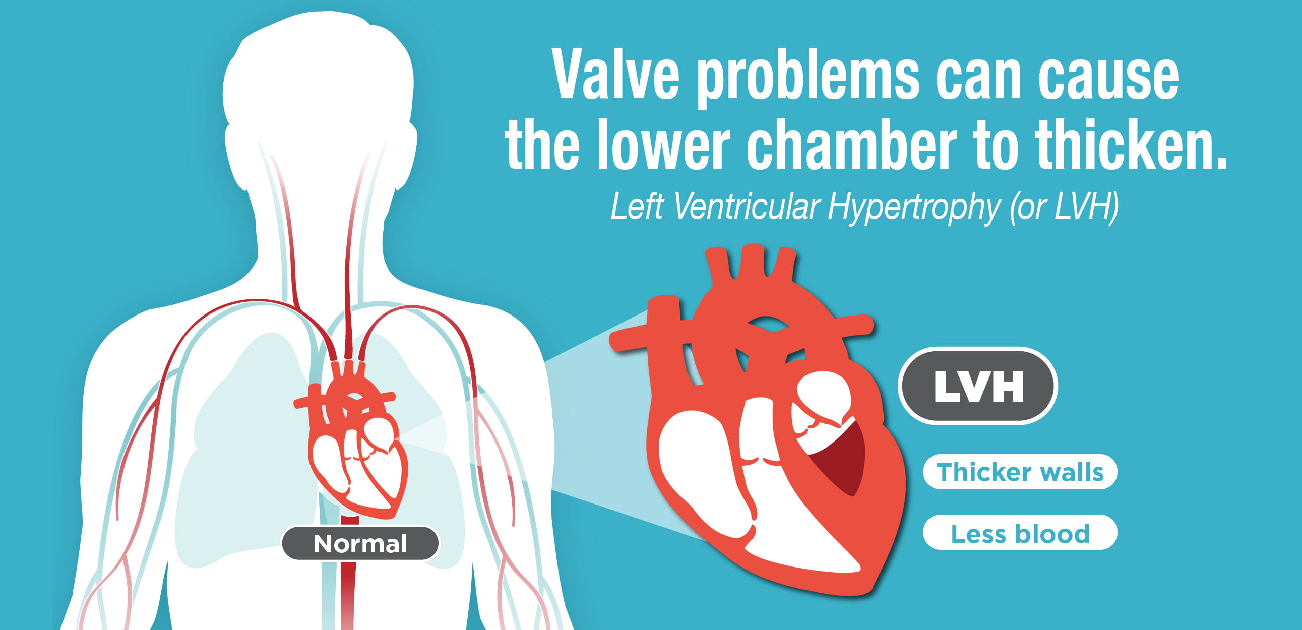 Left Ventricular Hypertrophy LVH banner