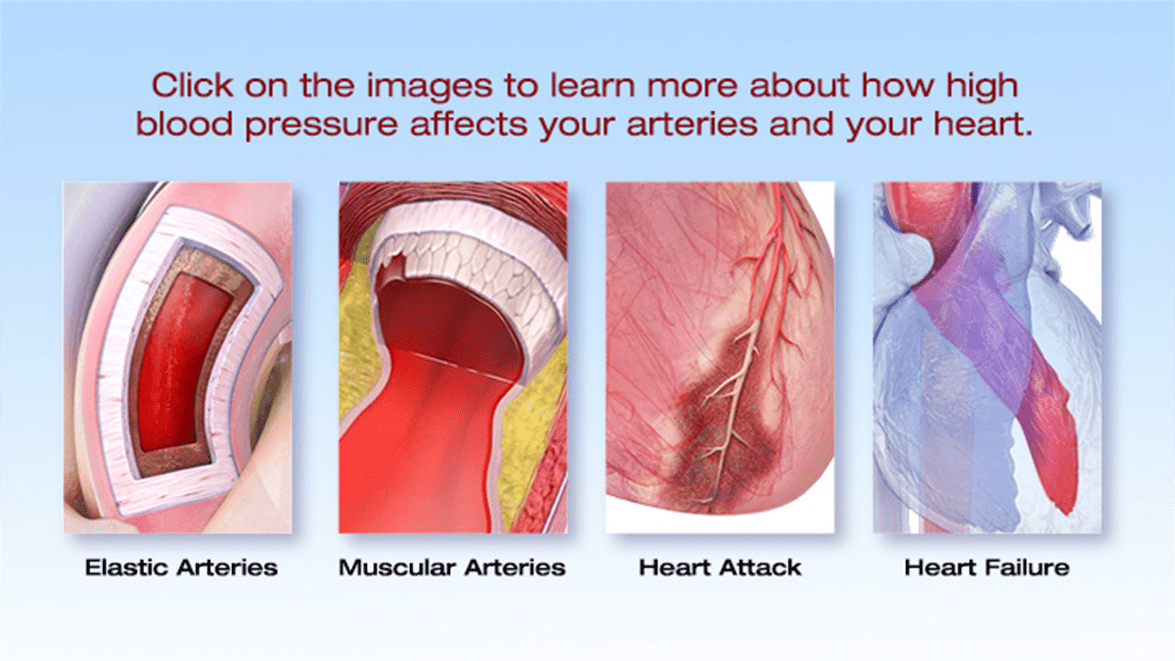 high blood pressure causes stroke