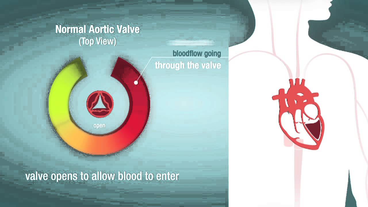 Heart Valve Stenosis video screenshot