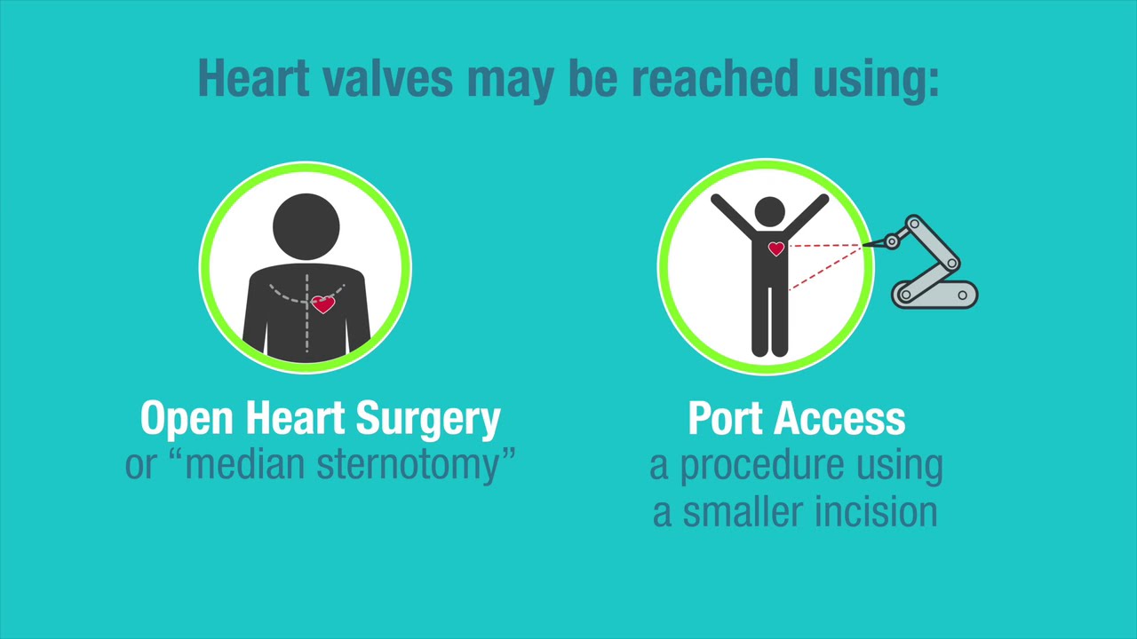 Types of Replacement Heart Valves American Stroke Association