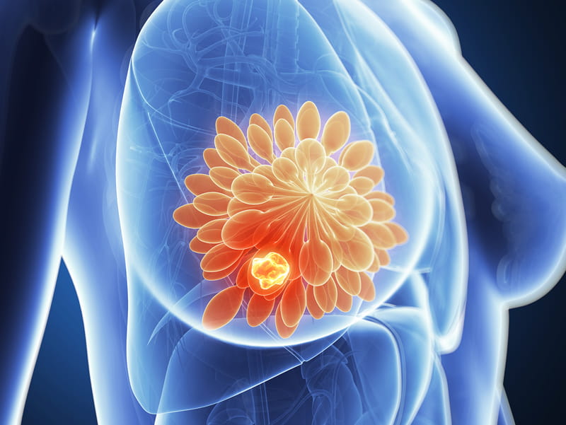 Illustration of breast cancer.