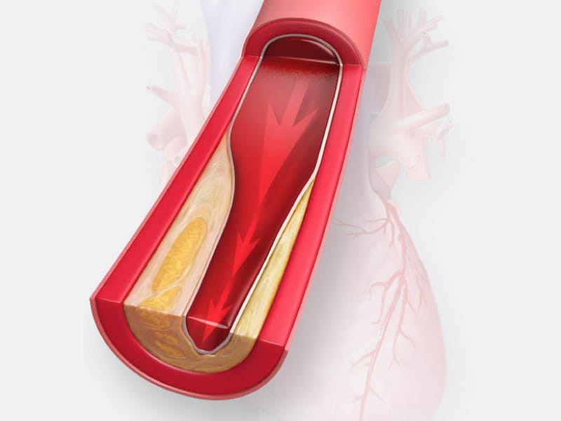 Image of artery narrowed with cholesterol. (Scott Bodell for American Heart Association)