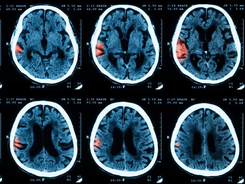 Image of brain scan with stroke.