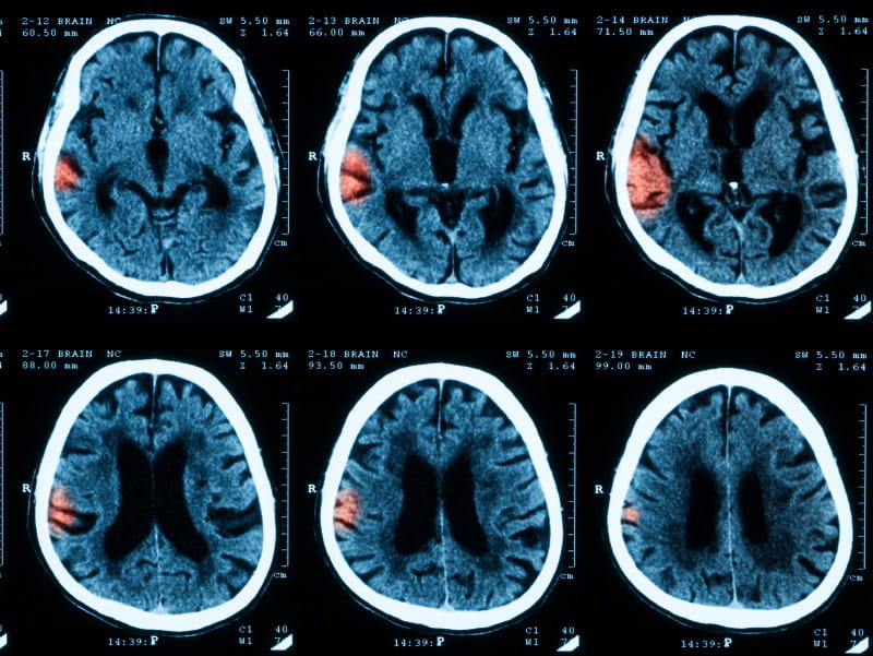 Image of brain scan with stroke. 