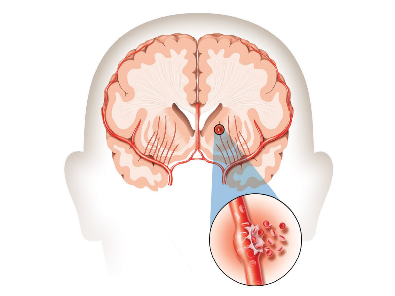 A hemorrhagic stroke occurs when a weakened blood vessel ruptures and spills blood into the brain. (American Heart Association/American Stroke Association)