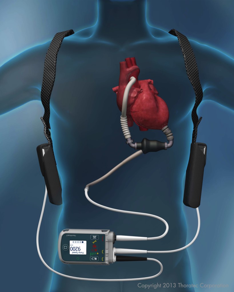 Illustration of HeartMateII in the body
