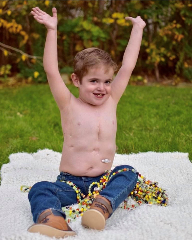 Bennett Sayles triumphantly shows off his heart surgery scars and is surrounded by his "Beads of Courage," in which each bead represents every blood draw, intubation and major surgery he's endured. (Photo by JoAnne Broetzmann)