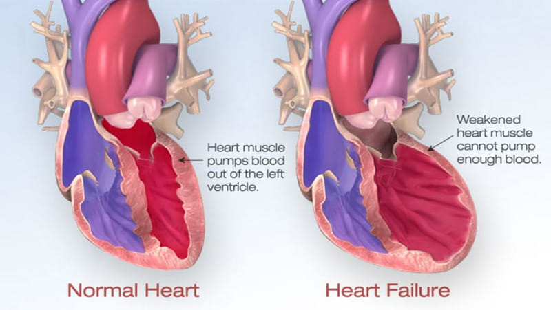 (American Heart Association)