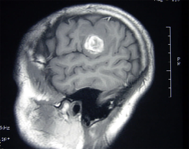 A scan of Lawrence Schwartz's brain, with the tumor highlighted. (Photo courtesy of Lawrence Schwartz)