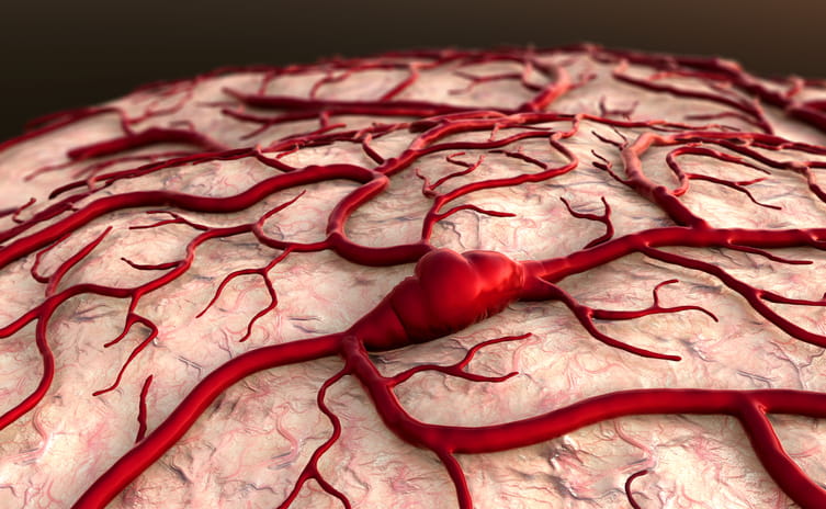 arteriovenous malformation