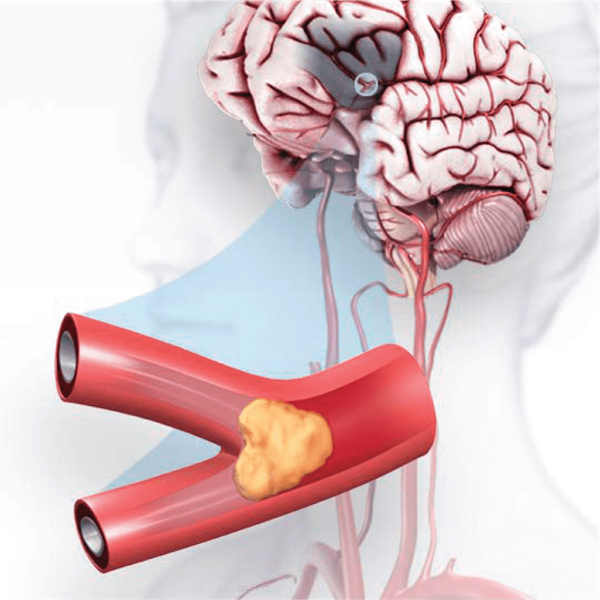 digital illustration of a stroke