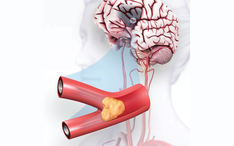 Ischemic Strokes (Clots) | American Stroke Association