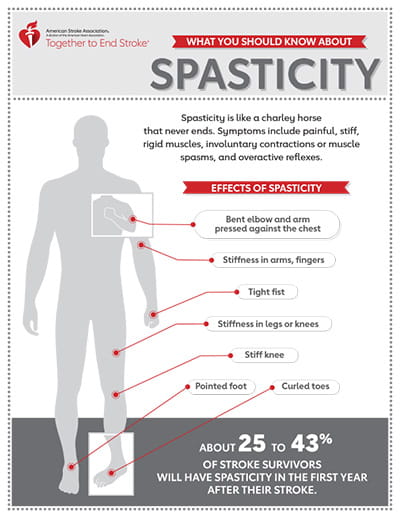 thumbnail image of the What You Should Know About Spasticity infographic
