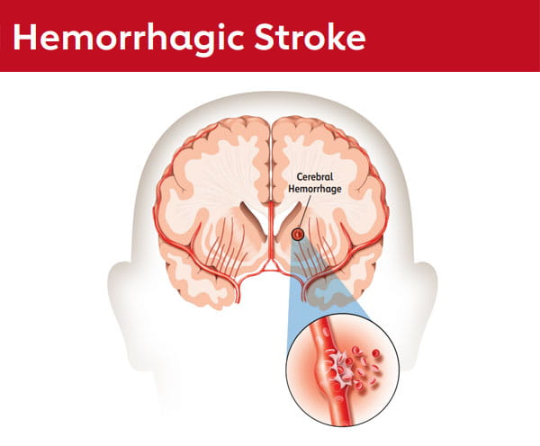 Hemmorrhagic Stroke graphic