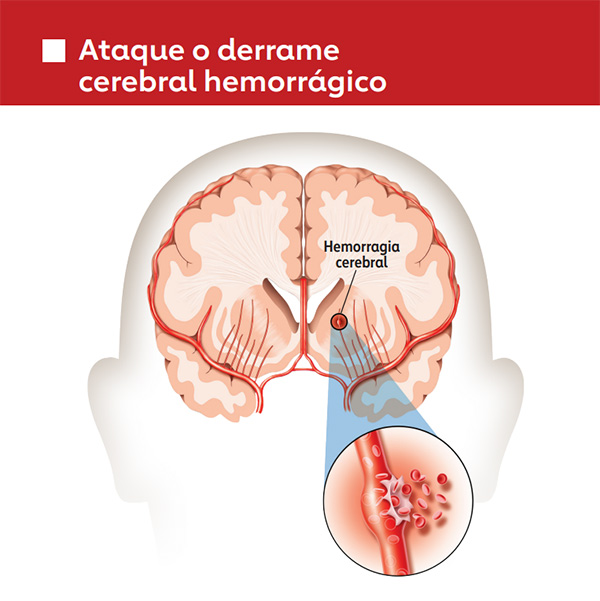 Gráfico de accidente cerebrovascular hemorrágico