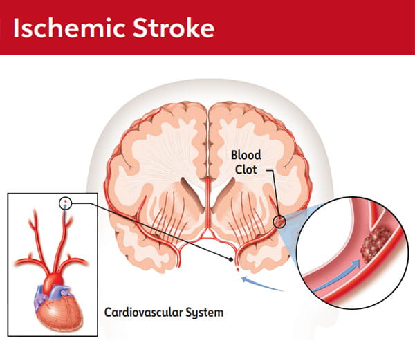 Ischemic Stroke graphic