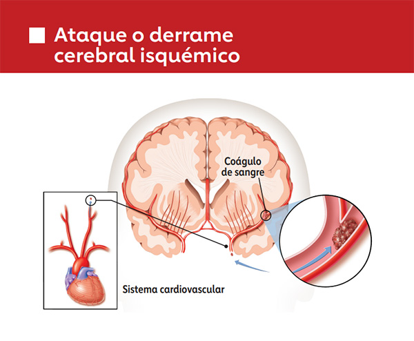 Gráfico de accidente cerebrovascular isquémico