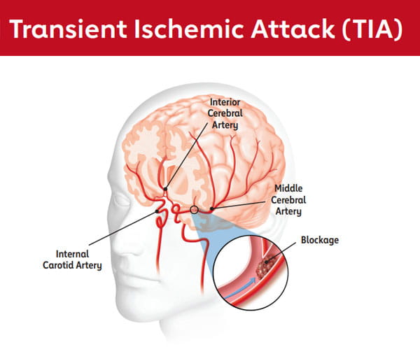 Ischemic Stroke graphic