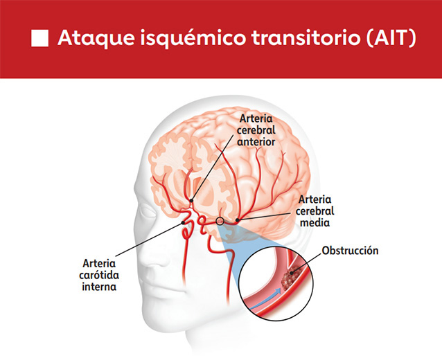 Gráfico de ataque isquémico