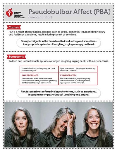 Pseudobulbar Affect Infographic front