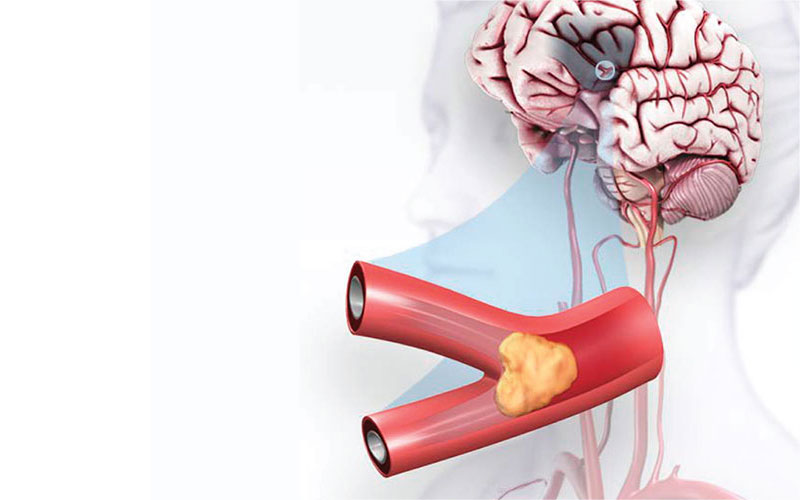 Types of Stroke | American Stroke Association