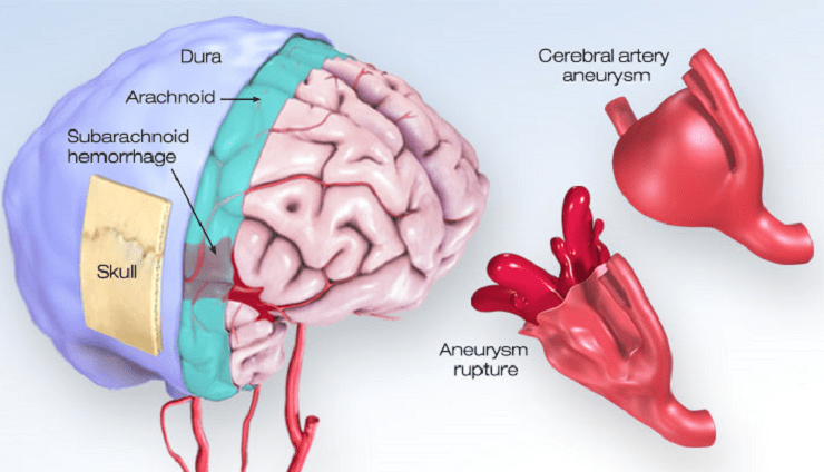 Brain Aneurysm Size Chart