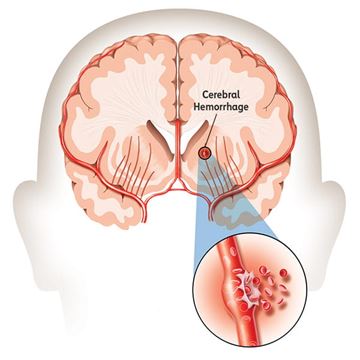 medical illustration of a cerebral hemorrhage medical illustration of a cerebral hemorrhage