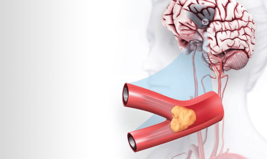Digital illustration of a human brain and blocked blood vessel