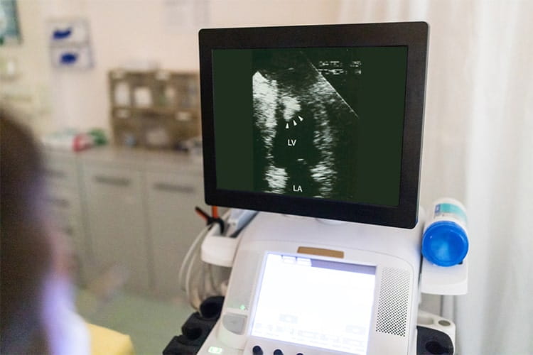 Monitor of an echocardiogram showing a thombus in the left venticle on the screen