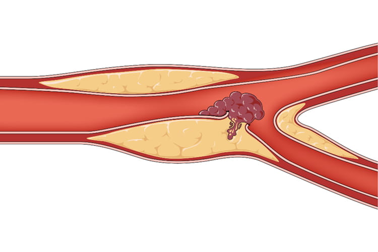 guideline for acute coronary syndromes illustration