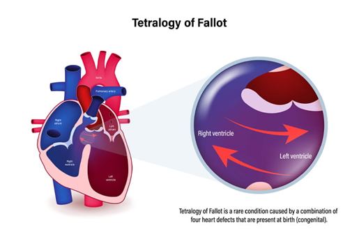 tetralogy of fallot
