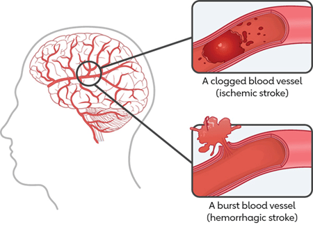 Digital illustration of blood vessels in the brain depicting a clot and a rupture. Digital illustration of blood vessels in the brain depicting a clot and a rupture.